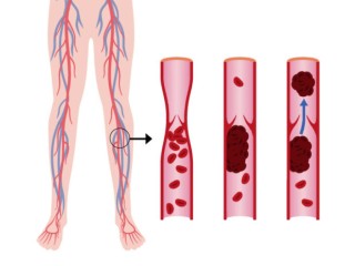 Best Cardiologist for Deep Vein Thrombosis