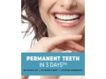 permanent-teeth-implants-in-india-small-0