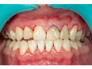 Best Gum Disease treatment in Madhapur, Hyderabad