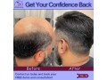 non-surgical-hair-replacement-baldness-solutions-in-delhi-small-0