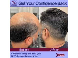 Non-Surgical Hair Replacement & Baldness Solutions in Delhi