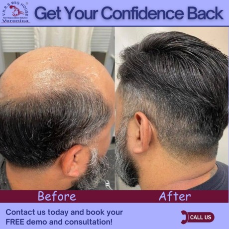 non-surgical-hair-replacement-baldness-solutions-in-delhi-big-0