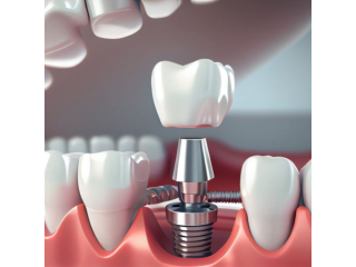 Best Dental Implants in Hyderabad